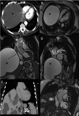 (A) Axial thoracic computed tomography showing a giant cyst (*) compressing the right heart. (B) Four-chamber view, balanced turbo field-echo (BTFE) cardiovascular magnetic resonance (CMR) showing a giant cyst (*) compressing the right heart. (C) Left ventricular tract outflow (LVOT) view, BTFE CMR showing a giant cyst (*) compressing the right atrium (black arrow). (D) BTFE CMR sagittal view of the cyst extension. (E) Coronal thoracic computed tomography after the cyst resection. (F) BTFE CMR showing the LVOT view after the cyst resection.