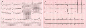 Electrocardiogram of the patient on admission (A) showing wide complex tachycardia with left bundle branch block morphology and superior axis and after electrical cardioversion (B) showing T wave inversion from V1 to V5 in sinus rhythm.
