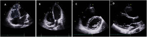 Transthoracic echocardiogram images showing slight RV dilatation (33 mm), most evident at the apex level (with trabeculation). Echocardiogram images also showed hypocontractility of the right ventricular free wall and slight depression of its function.