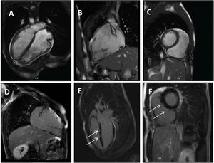 Panel A–C: CINE CMR images showing marked RV dilatation (end diastolic volume indexed to body surface area of 180 ml/m2), global hypokinesis and dyssynchronous RV contractility with mild depression of its function (42%); Panel D–F: late-enhanced CMR showing subepicardial late enhancement in the distal septum and two small foci of subepicardial late enhancement in the middle segment of the inferoseptal wall (arrows).