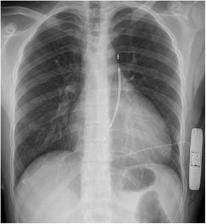 Chest X-ray after subcutaneous ICD implantation.