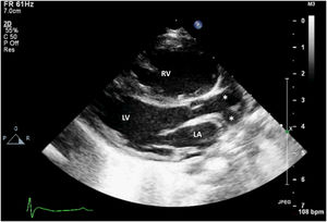 Transthoracic two-dimensional echocardiographic still, parasternal long-axis projection, showing the bifurcating great artery arising from the left ventricle (asterisks). LA: left atrium; LV: left ventricle; RV: right ventricle.