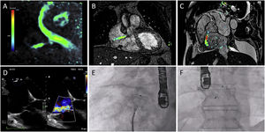 Preprocedural assessment and percutaneous closure. Left-to-right shunt during the entire cardiac cycle between the right aortic sinus and the right atrium can be noted on 4D-flow magnetic resonance angiography (A–C). Transesophageal echocardiography confirmed the shunt and revealed a funnel structure between the inferior aspect of the aortic root and immediately superior to the septal tricuspid leaflet (D). Percutaneous closure was performed employing an Amplatzer Septal Occluder device (Abbot Medical, E and F).