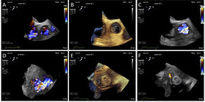 Three-dimensional (3D) transesophageal echocardiographic defect assessment before and after percutaneous closure. Left-to-right shunt assessment before (A and D) and after procedure (B–C and E–F) can be easily compared on the same 3D echocardiography views. A–C: top view from proximal ascending aorta; D–F: en face views of the defect from the right atrium.