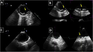 Two-dimensional (2D) and three-dimensional (3D) transesophageal echocardiography (TEE) images of thoracic aorta, showing ulcerations seen both in 2D (A) and 3D TEE (B). A small ulcer is not visualized in 2D (C) but only in 3D TEE (D).