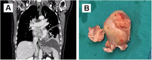 (A) Coronal view of thoraco-abdominal computed tomography scan before the first surgery. A left atrial tumor is observed extending into the right inferior pulmonary vein outlet; (B) mass resected during the first surgery, elastic in consistency with protuberant characteristics and mother-of-pearl surface color. Part of the interatrial septum can be observed at its base.