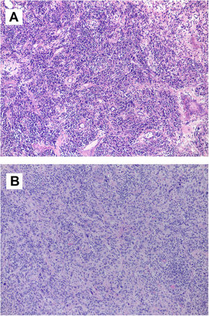 (A) Microscopic image of inflammatory myofibroblastic tumor. Tumor lesion of heterogeneous cellularity in a loose stroma, which varies from mucoid to dense with abundant collagen. It is vascularized by dilated vessels of variable caliber, some thrombosed. The predominant cells are lymphocytes and plasma cells, polyclonal inflammatory in nature, which mask the stromal cells. There is no atypia or mitosis. Other areas contain fibrohistiocytes and multinucleated giant cells, some undergoing mitosis; (B) microscopic image of intimal sarcoma. Proliferation of elongated spindle and stellate cells that grow interconnected in long, ill-defined bundles infiltrating the cardiac muscle. The cells show marked nuclear pleomorphism, without necrosis. There are three mitoses per 10 high-power fields.