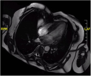 Axial view of cardiac magnetic resonance images for a more detailed characterization of the recurrent mass previous to the second surgery. Late contrast enhancement can be seen within the tumor in the right atrium.