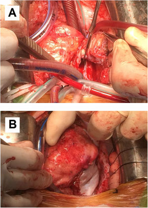 Photographs taken during redo surgery. (A) Resection of mass attached to the right atrial free wall and extending from the superior vena cava to the inferior vena cava with no clear resection boundaries; (B) right atrial free wall reconstruction with pericardial patch.