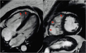 (A) Cardiac magnetic resonance (CMR) horizontal long-axis CINE right ventricular (RV) anterior wall aneurysms; (B) CMR short-axis CINE RV anterior wall aneurysms.
