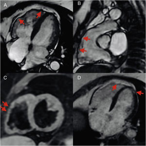 (A) Cardiac magnetic resonance (CMR) horizontal long-axis CINE right ventricular (RV) anterior wall aneurysms; (B) CMR CINE RV outflow tract aneurysms; (C) axial black blood T1 RV free wall irregularities (fat infiltration); (D) RV apical and LV apical lateral wall late gadolinium enhancement.
