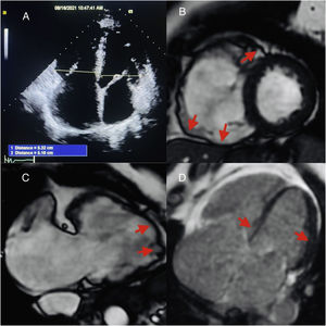 (A) Echo Apical 4-chamber view, increased RV/LV ratio; (B) cardiac magnetic resonance (CMR) short-axis CINE dilated thin RV with aneurysms; (C) CMR RV 2-chamber with apical aneurysms; (D) mid basal septum and epicardial lateral wall late gadolinium enhancement.