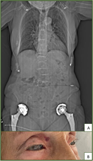 Radiography showing degenerative arthritis of multiple joints, including vertebral column, and bilateral total hip replacements (A) and blue-gray ocular deposits on both conjunctivae (B).