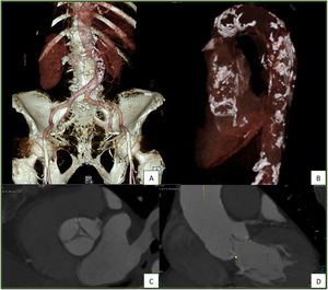 Volume rendering technique (VRT) reconstruction of the abdominal aorta and iliofemoral arteries, the latter without significant calcification or stenosis (A); left anterior oblique VRT reconstruction of the thoracic aorta, disclosing extensive, multifocal calcified plaques (porcelain aorta) (B); short-axis (C) and coronal (D) reconstructions of the aortic valve at 20% of the RR interval, disclosing restricted systolic leaflet motion and mild commissural calcification.