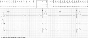 24-Hour Holter recording showing nocturnal complete atrioventricular block (ventricular pause of 6.6 s).