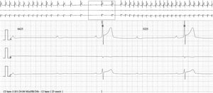 24-Hour Holter recording showing nocturnal complete atrioventricular block (ventricular pause of 6.6 s).