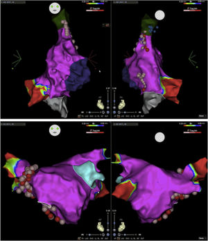 Electroanatomic map with anteroposterior and posteroanterior views of the right atrium showing radiofrequency (RF) applications (pink and red dots) on the septal aspect of the superior vena cava and near the coronary sinus ostium (above); left atrium and RF applications on the anterior aspect of the right pulmonary veins (below).