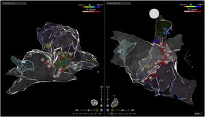 Electroanatomic map showing superior (right) and posterior (left) views of the right and left atria and radiofrequency applications on both sides of the atrial septum (pink and red dots).