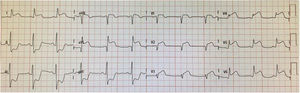 Admission 12-lead electrocardiogram. Twelve-lead electrocardiogram showing sinus rhythm and anterolateral ST-segment elevation.