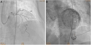 A/Clip 1A. Cardiac catheterization. Left heart catheterization showing slow flow in the left main coronary artery and its branches. B/Clip 1B. Cardiac catheterization. Left heart catheterization showing myocardial microcirculation contrast retention. LAD: left anterior descending coronary artery; LCx: left circumflex coronary artery; LM: left main coronary artery; LV: left ventricle.