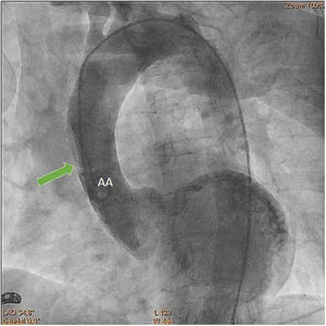Clip 2. Aortography. Aortography showing an intimal flap in the ascending aorta (green arrow). AA: ascending aorta.