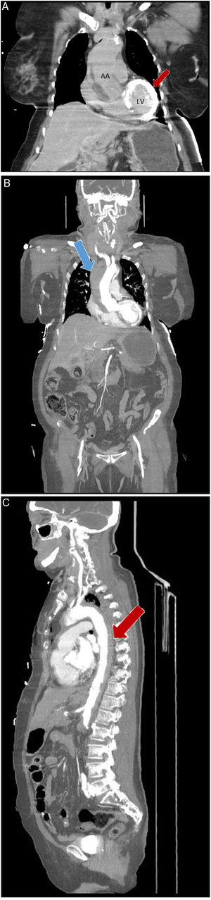 (A) Coronal computed tomography. Non-contrast-enhanced coronal computed tomography showing myocardial contrast retention in the left ventricle wall (red arrow). (B) Coronal computed tomography. Contrast-enhanced coronal computed tomography showing intramural hematoma in ascending aorta (blue arrow). (C). Axial computed tomography. Contrast-enhanced axial computed tomography showing intramural hematoma in descending aorta (red arrow). AA: ascending aorta; LV: left ventricle.