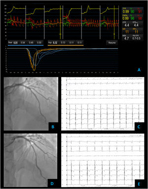 Non cardiac chest pain – coronary vascular function testing was performed using the thermodilution technique. Coronary flow reserve (4.4) and index of microvascular resistance (11) were both normal (A). Baseline coronary angiography with no obstructive CAD (B) and no epicardial vasospasm on maximal dose (200 mcg) acetylcholine provocation testing (D). The patient