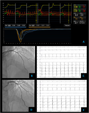 Non cardiac chest pain – coronary vascular function testing was performed using the thermodilution technique. Coronary flow reserve (4.4) and index of microvascular resistance (11) were both normal (A). Baseline coronary angiography with no obstructive CAD (B) and no epicardial vasospasm on maximal dose (200 mcg) acetylcholine provocation testing (D). The patient's electrocardiogram (E) also did not significantly change from baseline (C).