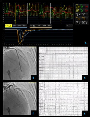 Vasospastic angina – coronary vascular function testing was performed in the LAD using the thermodilution technique. The LAD had no obstructive lesions – FFR 0.86 (A and B). Coronary flow reserve (3.0) and index of microvascular resistance (13) were both normal (A). In acetylcholine provocation testing, there was a significant diffuse reduction of diameter in the mid and distal LAD (D), accompanied by inferior and lateral ST depression (E), which were not present at baseline (C) and complaints of angina.