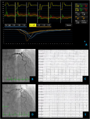 Microvascular angina – coronary vascular function testing was performed in the LAD using the thermodilution technique. The LAD had no obstructive lesions – FFR 0.92 (A and B). Both coronary flow reserve (1.3) and index of microvascular resistance (47) were abnormal high at 47 (A). There was no change in flow or vessel diameter on acetylcholine challenge (D) neither in the electrocardiogram comparing to baseline (C and E).