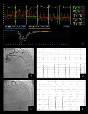 Combined microvascular and vasospastic angina – coronary angiography revealed tortuous coronary arteries with no epicardial obstruction – FFR 0.92 (A and B). Coronary vascular function testing was performed in the LAD using the thermodilution technique. Both coronary flow reserve (0.8) and index of microvascular resistance (34) were abnormal (A). On acetylcholine provocation testing, there was a severe and diffuse vasospasm in the LAD and LCX (D), accompanied by inferior and lateral ST depression (E), which were not present at baseline (C).