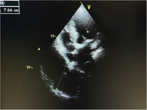 First transthoracic heart echocardiogram (parasternal long axis view) depicting an echolucent mass at the site of pericardium.