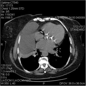 Urgent thorax and abdomen contrast CT-scan depicting an enormous pericardial cyst (6.6 cm×14.7 cm) located at the right cardiophrenic angle, causing atelectasis of the right middle and lower lung lobe.