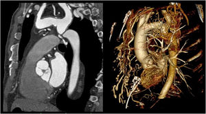 A cardiac gated CT scan revealed a transverse arch slightly hypoplastic with reduction of the luminal diameter (14 mm×19 mm). “Pencil tip” stenosis of the isthmic area of the aorta without continuity between the two arterial lumens. Collateral circulation, mainly due to the intercostals, internal mammary and epigastric arteries was noted.