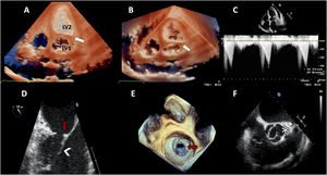 Transthoracic and transesophageal echocardiograms showing the presence of a double-chambered left ventricle; white arrow indicates the fibromuscular bundle separating the left ventricle into superior and inferior chambers (LV1 and LV2 respectively) (A–C); supravalvular mitral membrane (red arrow) (D and E); parachute mitral valve (D, arrowhead); and bicuspid aortic valve (F, asterisk).