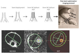 Imaging protocol included high definition IVUS (HD-IVUS), phased-array digital IVUS (IVUS) and OCT. The intravascular imaging modalities were sequentially done in five 3d-printed anatomies after stent implantation and optimization in the simulator. The black lines in the top right show the location of the images that were chosen for coregistration.