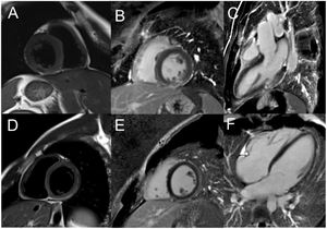 Role of cardiac magnetic resonance in the diagnostic approach of patients with myocardial infarction with non-obstructive coronary arteries (MINOCA). (A–C) Cardiac magnetic resonance (CMR) imaging of a 38-year-old male patient admitted with MINOCA. Cine imaging showed akinesia of the basal segment of the inferior wall. T2 (A) and late gadolinium enhancement (LGE) (B and C) sequences revealed recent almost transmural focal mid-cavity inferior infarction. A patent foramen ovale (PFO) was found and an embolic infarction was assumed. PFO closure was subsequently performed; (D–F) CMR imaging of a 39-year-old male patient admitted with MINOCA. T2 sequences (D) showed myocardial edema of the inferior and lateral walls with corresponding subepicardial LGE (E and F) in the same segments, thus enabling a diagnosis of myocarditis.