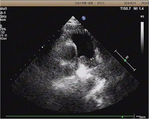 Echocardiogram revealing a mass arising from the main pulmonary artery (PA) and extending into the right and left PAs.