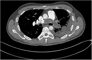 Computed tomographic angiography revealing a filling defect within the lumen main pulmonary artery (PA), extending into both right and left PAs.