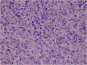 Tumor cells are spindle-shaped and pleomorphic, showing pathological mitosis, bunching and weaving arrangement, infiltrating growth. There is mucinous degeneration in some areas, abundant interstitial blood vessels, and some infiltration of chronic inflammatory cells.