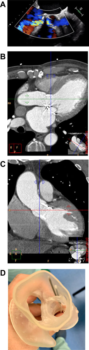 (A) Transesophageal echocardiography showing severe paravalvular leak (PVL) of the bioprosthetic aortic valve; (B and C) cardiac computed tomography images used to construct the three-dimensional (3D) printed models of the heart; (D–F) 3D printed model of the heart with simulation of PVL closure using three Amplatzer Vascular Plugs (AVP) (5-mm AVP III 14, 5-mm AVP III 10 and 5-mm AVP II); (G) fluoroscopy image of the procedure.