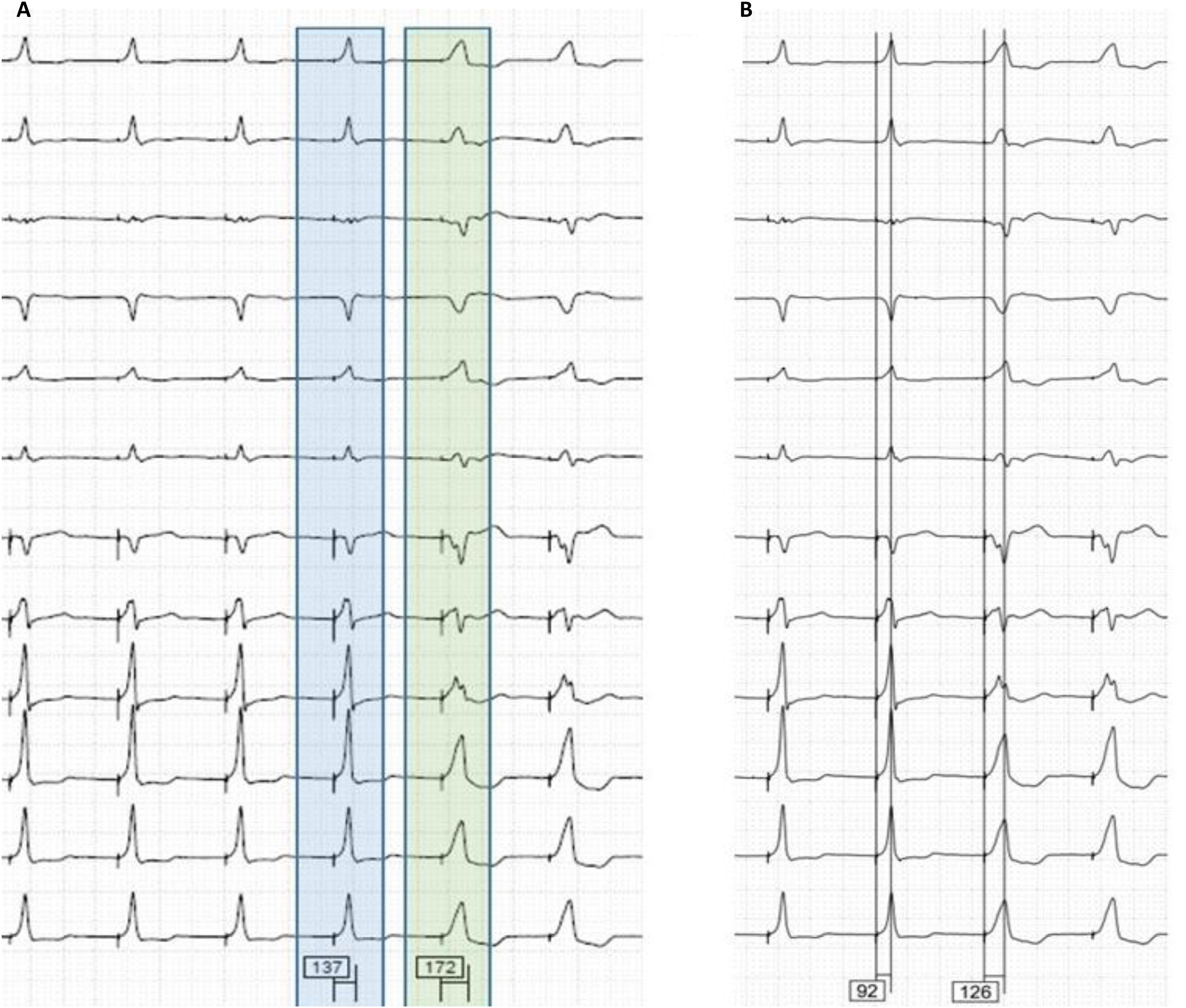 Timulus Passage His bundle pacing and left bundle branch area pacing: Feasibility and ...
