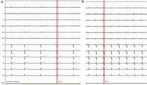 Selective His bundle pacing. (A) The 12-lead basal electrocardiogram at 25 mm/s demonstrating complete atrioventricular block, with a QRS 92 ms (inside red bars) and (B) after selective His bundle pacing, showing a paced QRS of 92 ms with the same morphology of native QRS (inside red bars).