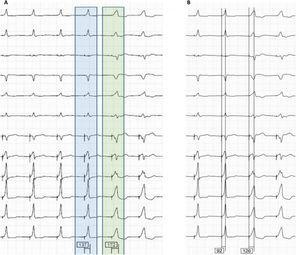 Non-selective His bundle pacing. (A) The 12-lead electrocardiogram at 25 mm/s demonstrating the passage from non-selective His bundle pacing (blue) to myocardial capture (green). The pacing stimulus to QRS interval is equal to zero given the presence of a pseudo-delta wave (blue arrow) and paced QRS is wider than native QRS. (B) Demonstration of non-selective His-bundle pacing with a R wave peak time in V6 <100 ms.