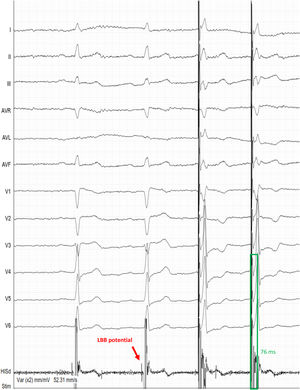 Left bundle brunch area pacing with a paced QRS morphology of right bundle branch block pattern and terminal R wave in lead V1, a stimulus-to-peak LV activation time is 76 ms in lead V6. Left bundle branch potential was also visible in the tip of the pacing lead (red arrow).