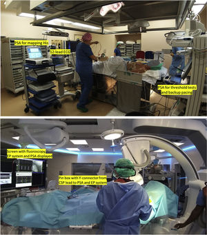 Top panel: Conduction system pacing setup at the University Hospital of Geneva in 2017 at the initiation of His bundle pacing. Bottom panel: Conduction system pacing since 2020 in the hybrid electrophysiology/device lab with an optimized setup. Legends: CSP: conduction system pacing; ECG: electrocardiograph; EP system: electrophysiology recording system; PSA: pacing system analyzer.