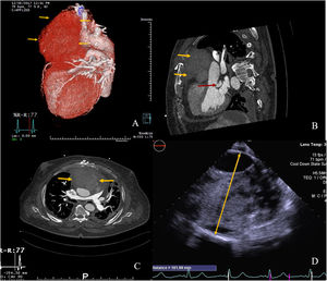 (A–C) Preoperative cardiac computed tomography (CCT). (A) Three-dimensional reconstruction showing the ascending aorta false aneurysm. (B) Two dimensional (2D) sagittal plane; yellow arrows: pseudoaneurysm eroding through the sternum; red arrow: periprosthetic posterior cavity. (C) 2D axial plane, yellow arrows: extrinsic main pulmonary artery compression due to pseudoaneurysm. (D) Intra-operative transoesophageal echocardiography (CT); yellow arrow: sizing of pseudoaneurysm (102 mm).