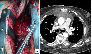 (A) Surgery: pseudoaneurysm cavity opened on top of figure; white arrow: bleeding from previous aortic cannulation site. (B) Postoperative cardiac computed tomography, drains are seen in the previous pseudoaneurysm cavity.