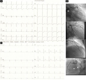 Electrocardiographic changes before and after stent angioplasty of the culprit lesion: (A) admission electrocardiogram depicting ST-segment depression at the J point in I, II, aVF, III and V3-V6 and ST-segment elevation at the J point in aVR and V1 (aVR>V1); (B) conventional coronary artery angiographic images depicting (top to bottom) acute proximal occlusion of the left circumflex artery (arrow), a good result after culprit lesion stenting, an unobstructed left anterior descending artery and high-grade lesions in the right coronary artery (arrowheads); (C) electrocardiogram after stent angioplasty of the culprit lesion depicting complete resolution of ST-segment changes and signs of inferior (QRS complex fragmentation in aVF and III) and lateral (R-wave amplitude and R/S amplitude ratio in V1 >3 mm and >0.5, respectively, and loss of R-wave height in V6) infarction.