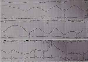 Continuous monitoring electrocardiogram – continuous monitoring electrocardiogram during syncope episode related with cervical unilateral pain showing an asystole period.